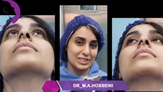 جراحی بینی زیباجوی 16 ساله