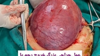 عمل جراحی بزرگ خروج رحم یا هیسترکتومی
