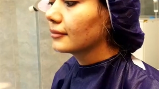 جراحی بینی گوشتی در اتاق عمل