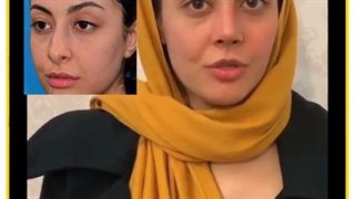 رضایت از عمل بینی