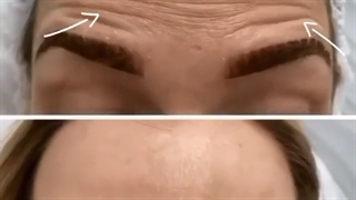 فیلم تزریق بوتاکس به پیشانی دندان شیری