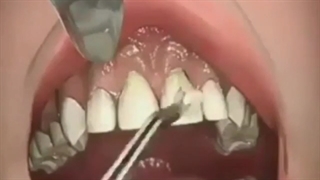 جراحی لیفت لثه ارتودنسی