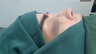 فیلم واقعی عمل جراحی بینی در اتاق عمل توسط دکتر علی طاهری نیا