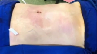 تزریق چربی به باسن دندان پیش