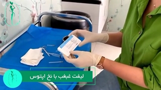 لیفت غبغب با نخ آپتوس