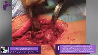 فیلم جراحی ناموفق مفصل ران در اطفال