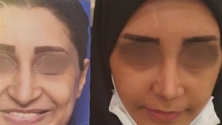 نمونه رضایت زیباجو از عمل جراحی بینی