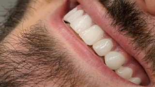 فیلم واقعی از انجام کامپوزیت ونیر ابرسانی پوست