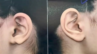 اصلاح بدشکلی لاله گوش