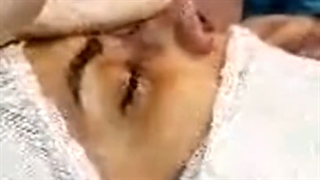 عمل بینی استخوانی در اتاق عمل