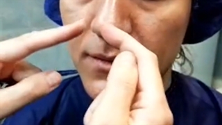 عمل بینی گوشتی