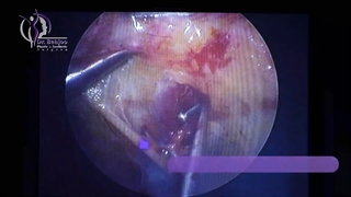 فیلم جراحی لیفت صورت در اتاق عمل با اندوسکوپی (2)