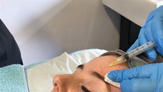 مزوتراپی صورت