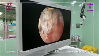 عمل جراحی اندوسکوپیک تومور مثانه