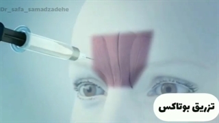 تزریق بوتاکس