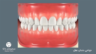 جراحی دندان عقل