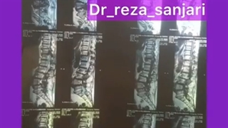 اصلاح تنگی کانال نخاعی در خانم 70 ساله