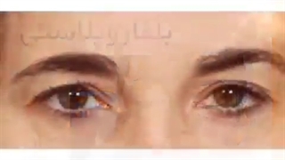 جراحی بلفاروپلاستی