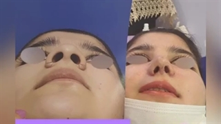 جراحی بینی یک ماه بعد از عمل بینی توسط دکتر الهام یعقوبی پلاستیک لثه