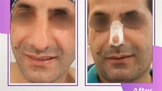 یک ماه بعد از عمل بینی توسط دکتر الهام یعقوبی