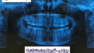 جراحی دندان ۶