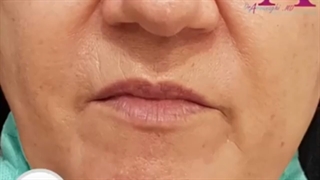 اصلاح خط خنده با فیلر هیالورونیک اسید توسط دکتر حمید ارونقی