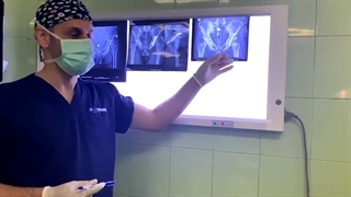 ااستفاده از برش خلفی جهت تعویض مفصل به دنبال شکستگی در رفتگی قبلی ران