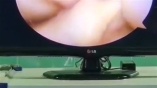 بازسازی acl از دکتر پویان علوی نژاد پیلینگ شیمیایی