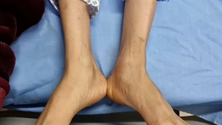 تعویض مفصل لگن در بیمار مبتلا به در رفتگی مادرزادی لگن