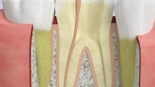 درمان ریشه دندان