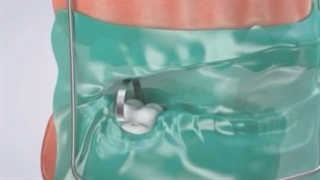 درمان ریشه دندان با دکتر معراجی