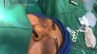 فیلم بدون سانسور عمل زیبایی بینی