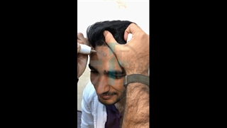 رفع جای زخم با دستگاه پلاسما الکتروسرجیکال