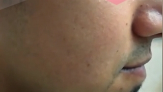 هزینه کاشت ریش و سبیل چقدر است؟