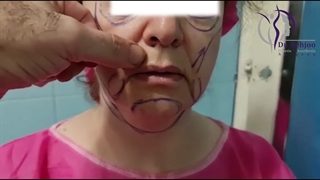 فیلم واقعی لیفت کامل صورت، شقیقه و سانترال لب