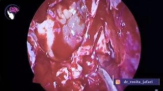 مراقبت های بعد از پولیپ بینی