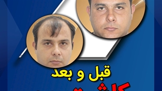 مدل کاشت مو