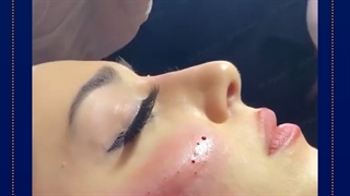 عمل بینی-فیلر بینی
