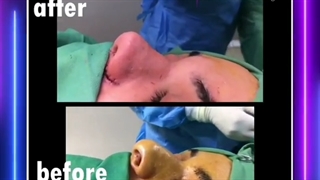 فیلم واقعی جراحی زیبایی بینی استخوانی