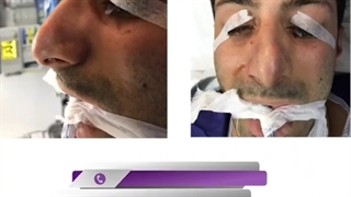 بلافاصله بعد از جراحی بینی آقای جوان