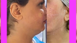 فیلم بدون سانسور تزریق نانوفت به صورت