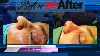 بلافاصله بعد از جراحی بینی گوشتی