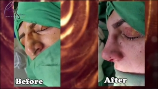 بلافاصله بعد از رینوپلاستی