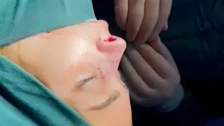 جراحی زیبایی بینی در اتاق عمل