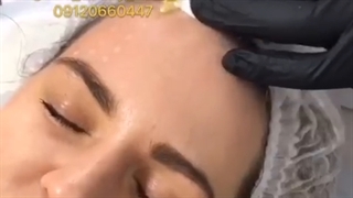 تزریق مزو ژل # 09120660447