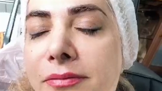 رفع خط خنده  و اندوه با نخ کلاژن ساز # 09120660447