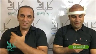 نمونه کاشت مو