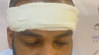 رضایت مندی از کاشت مو حرفه ای در کلینیک گلبان