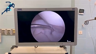 پارگی قدیمی باکت هندل منیسک داخلی| دکتر شیروانی بختیاری