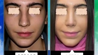 نمونه جراحی بینی ( 6 ماه بعد از عمل)